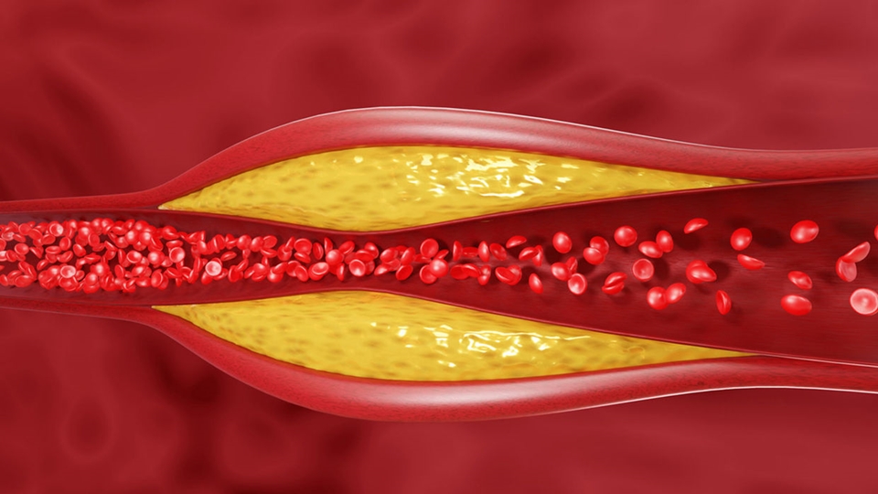 Ini Sejumlah Cara Menurunkan Kolesterol, Stress Salah Satunya