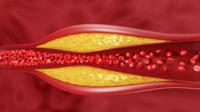Ini Sejumlah Cara Menurunkan Kolesterol, Stress Salah Satunya
