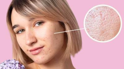 Sejumlah Penyebab Pori-Pori Besar dan Komedo yang Biasa Terjadi